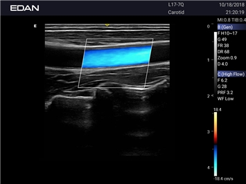 EDAN Acclarix AX3